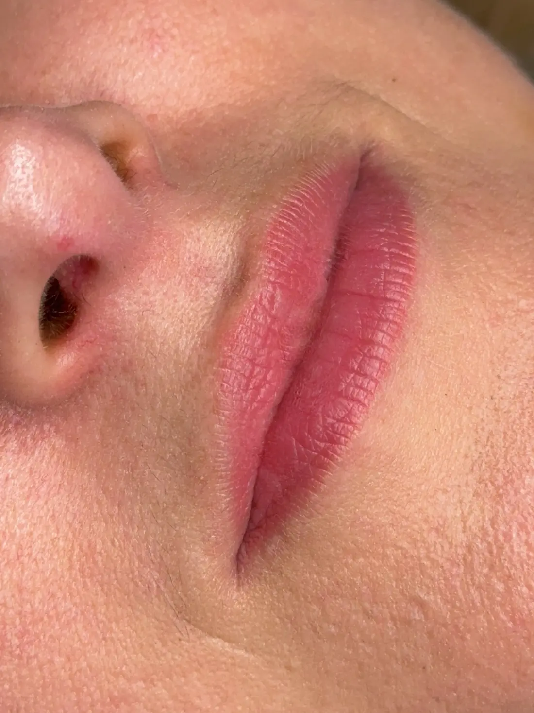 wygojone usta przed korekta